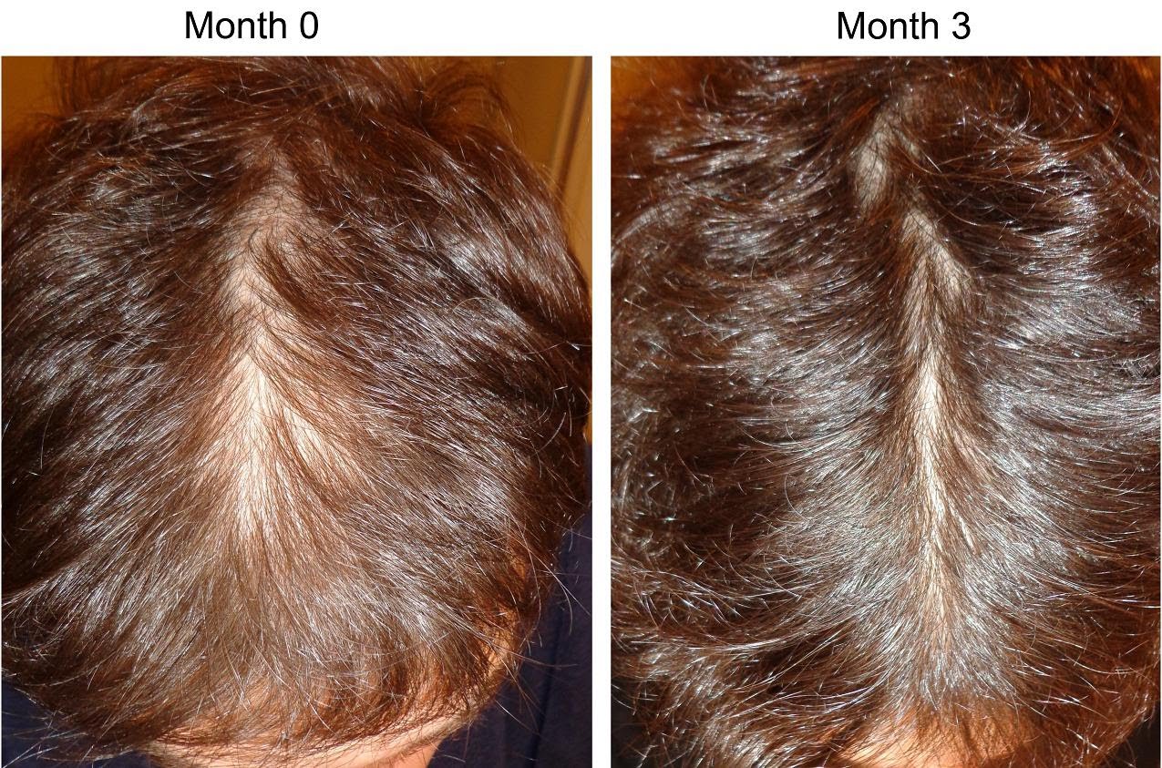 Nioxin Vs Rogaine